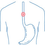 Esophagus cancer